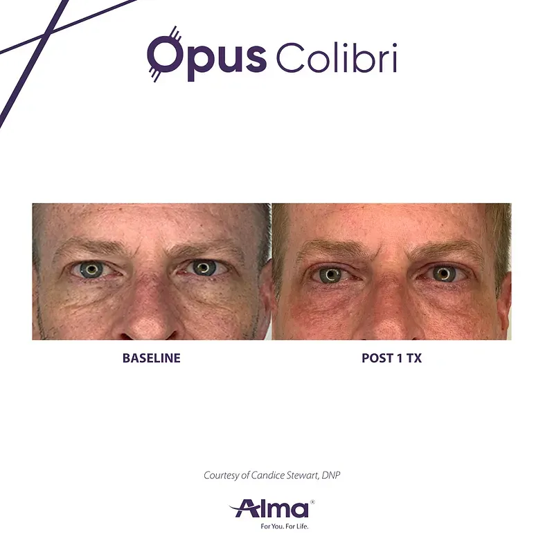 A before and after picture of a man 's eyes.