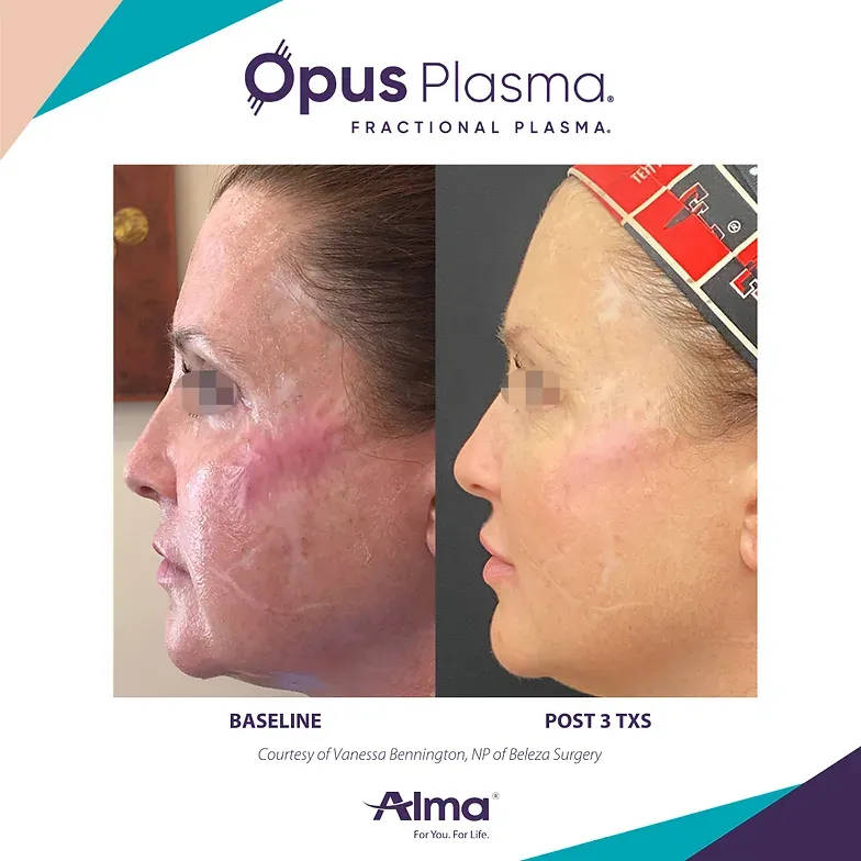A before and after photo of a woman 's face for opus plasma