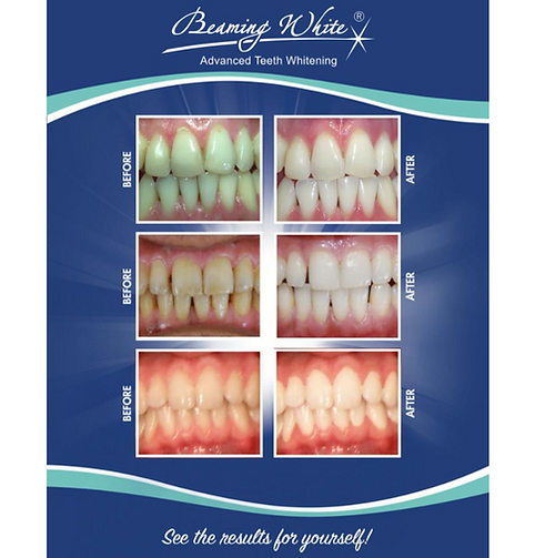 A before and after picture of a person 's teeth