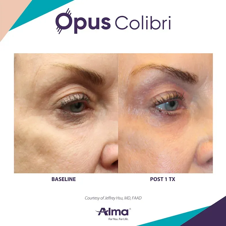 A before and after photo of a woman 's face for opus colibri