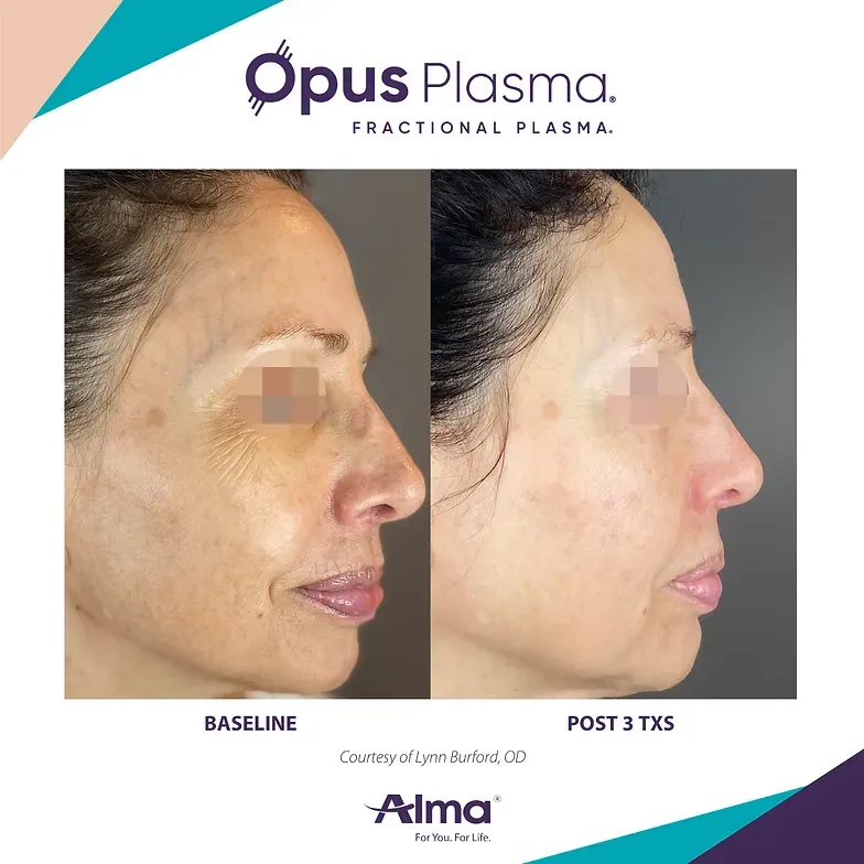A before and after photo of a woman 's face