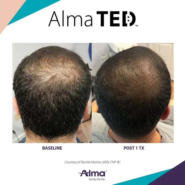 A picture of a man 's hair before and after alma ted treatment