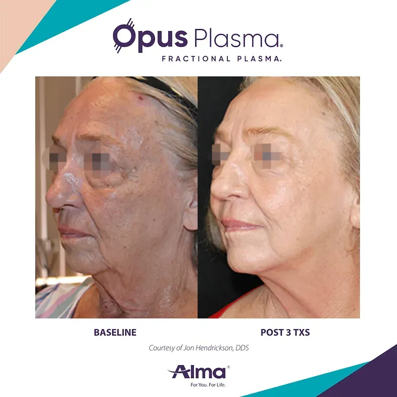 A before and after photo of a woman 's face with opus plasma written on the bottom