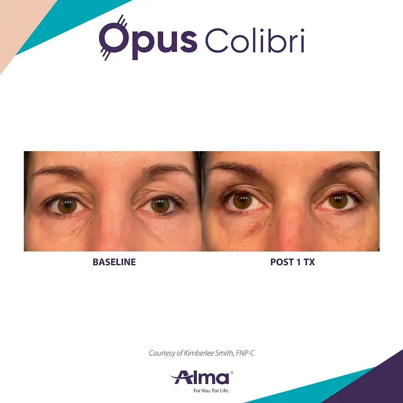 A before and after picture of a woman 's eyes.