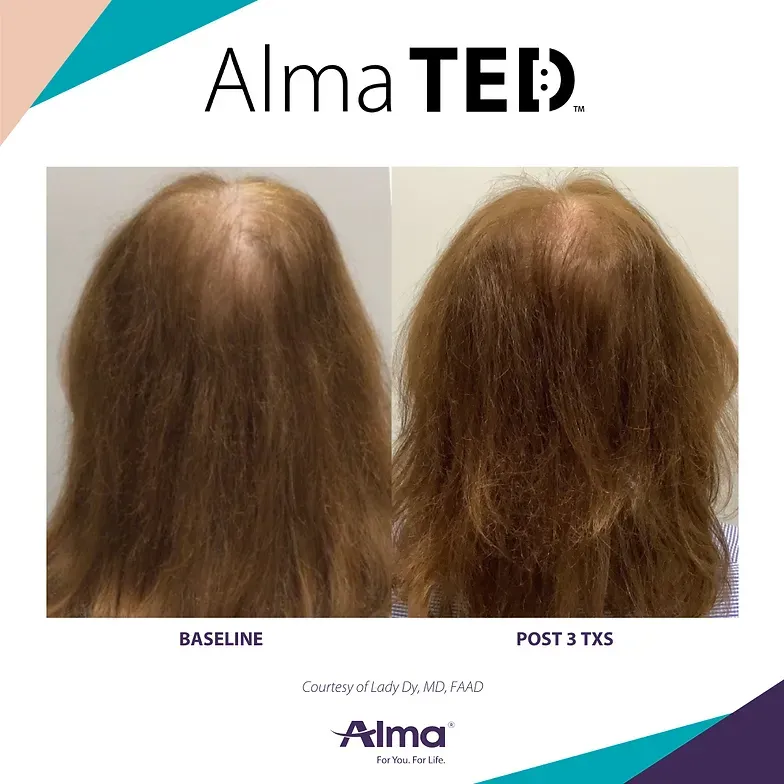 A picture of a woman 's hair before and after alma ted