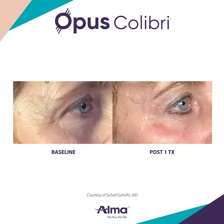 A before and after photo of a woman 's eye.
