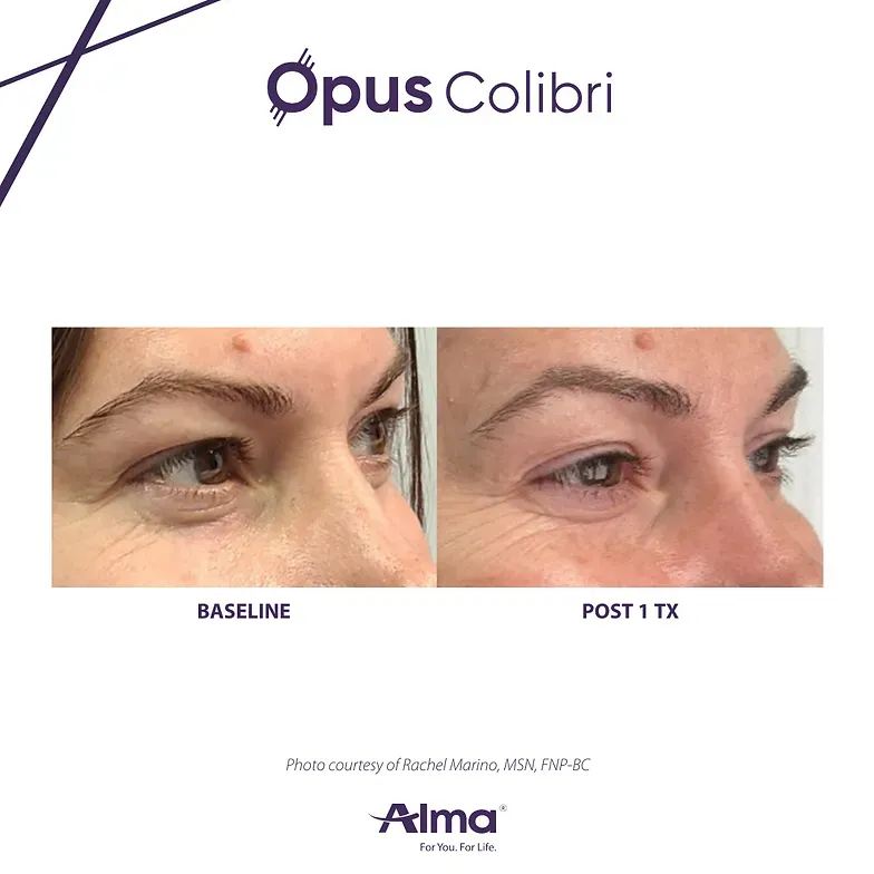 A before and after picture of a woman 's eye.