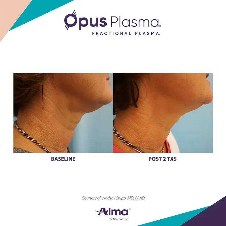 Comparison of neck skin before (baseline) and after two Opus Plasma treatments, showing reduced wrinkles.