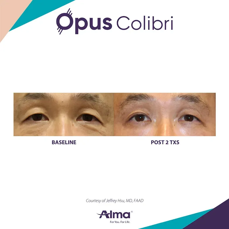 A before and after picture of a man 's eyes