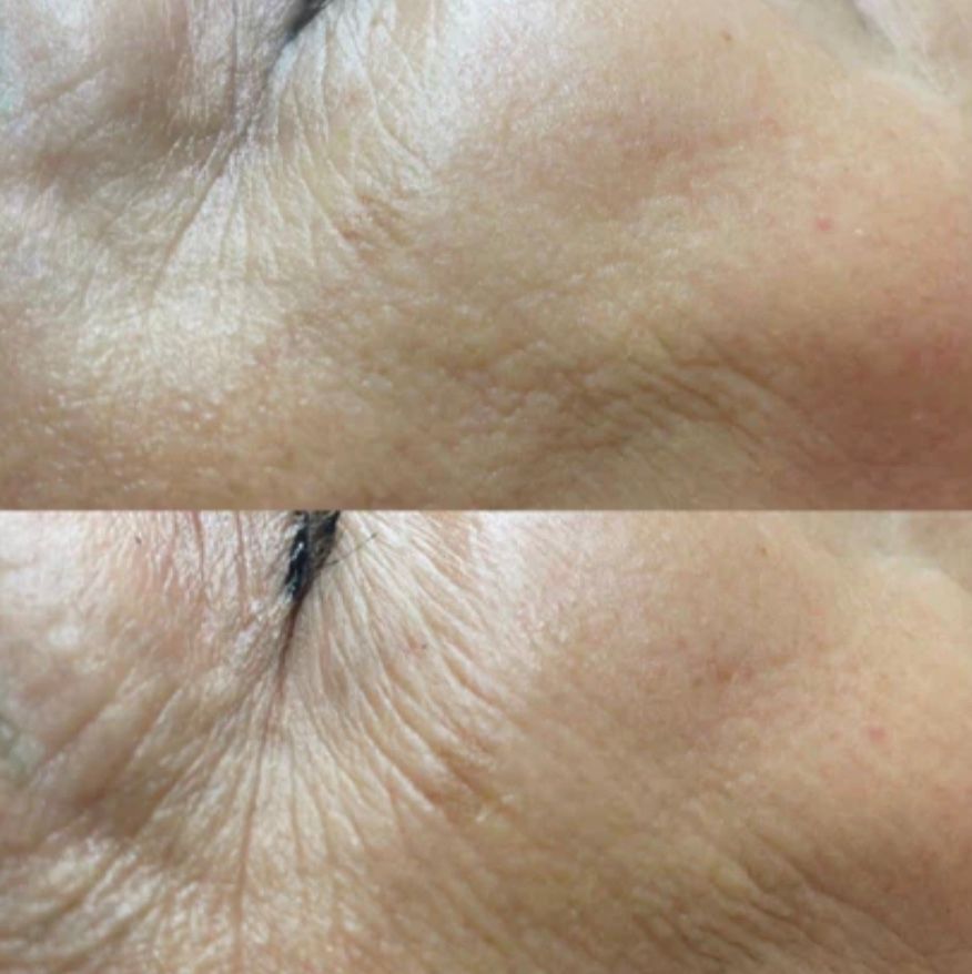 Top: close-up of eye area with wrinkles. Bottom: same area, smoother appearance after treatment.