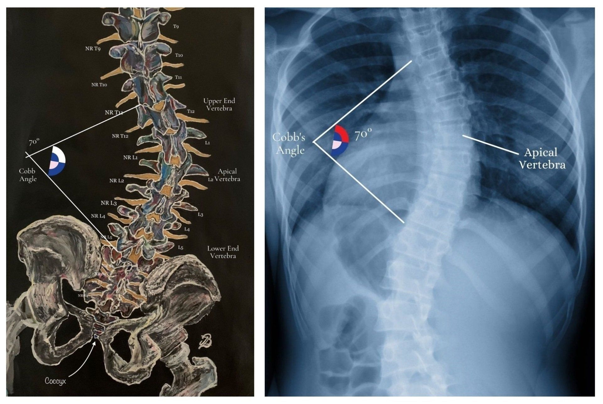 Cobb Angle of scoliotic curvature