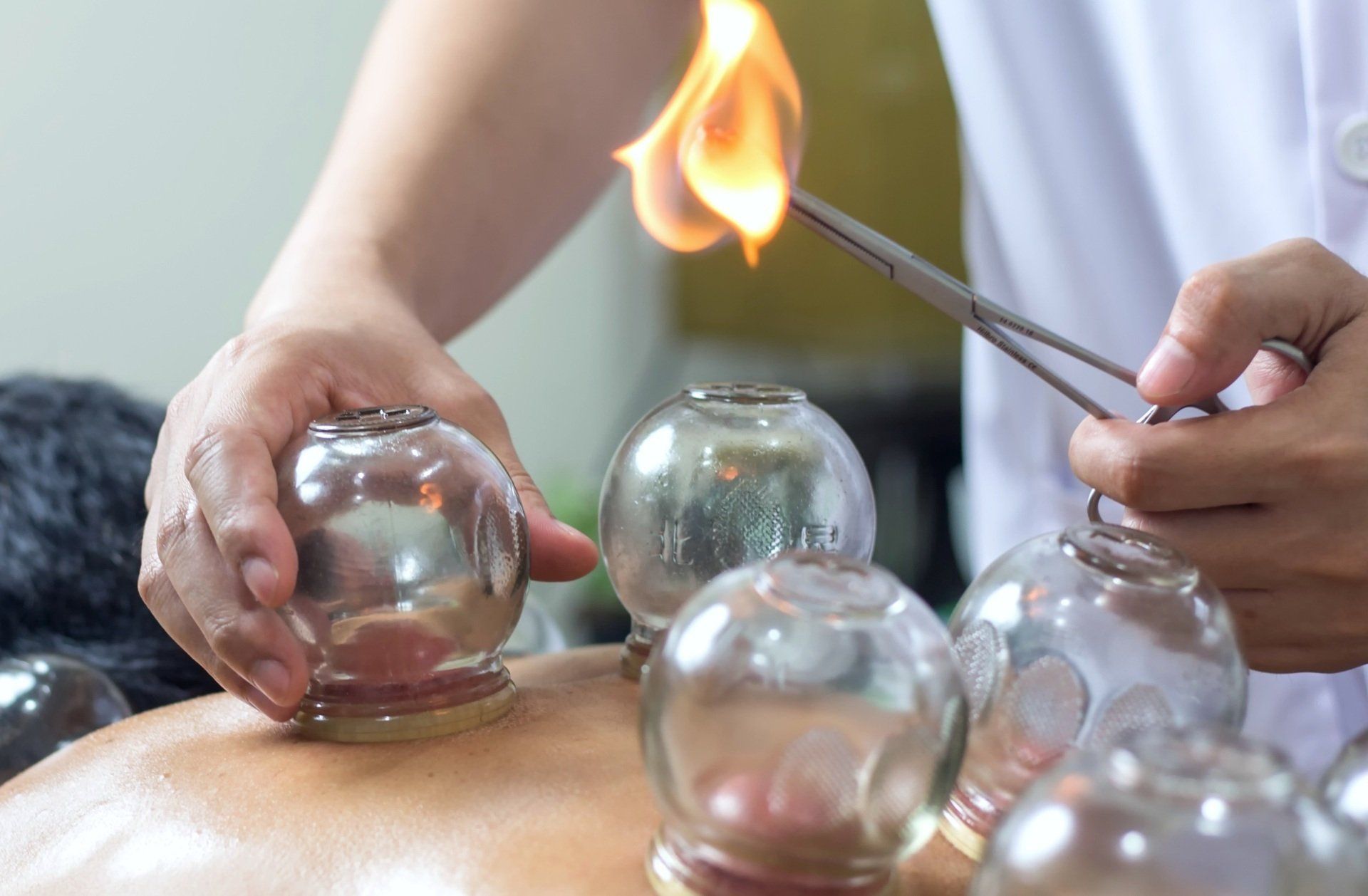 Fire Cupping