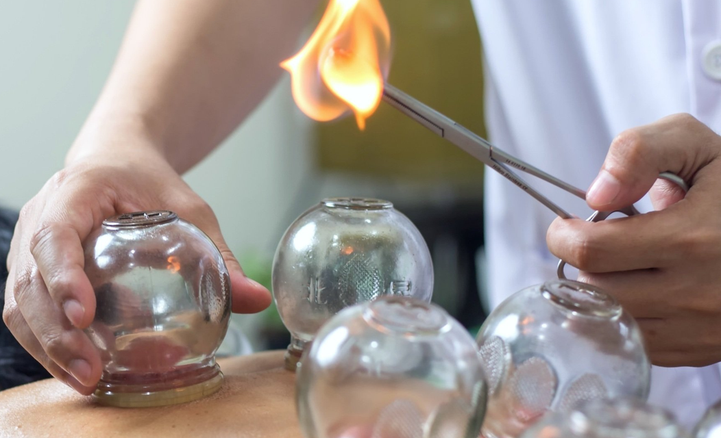 Dry Cupping Therapy