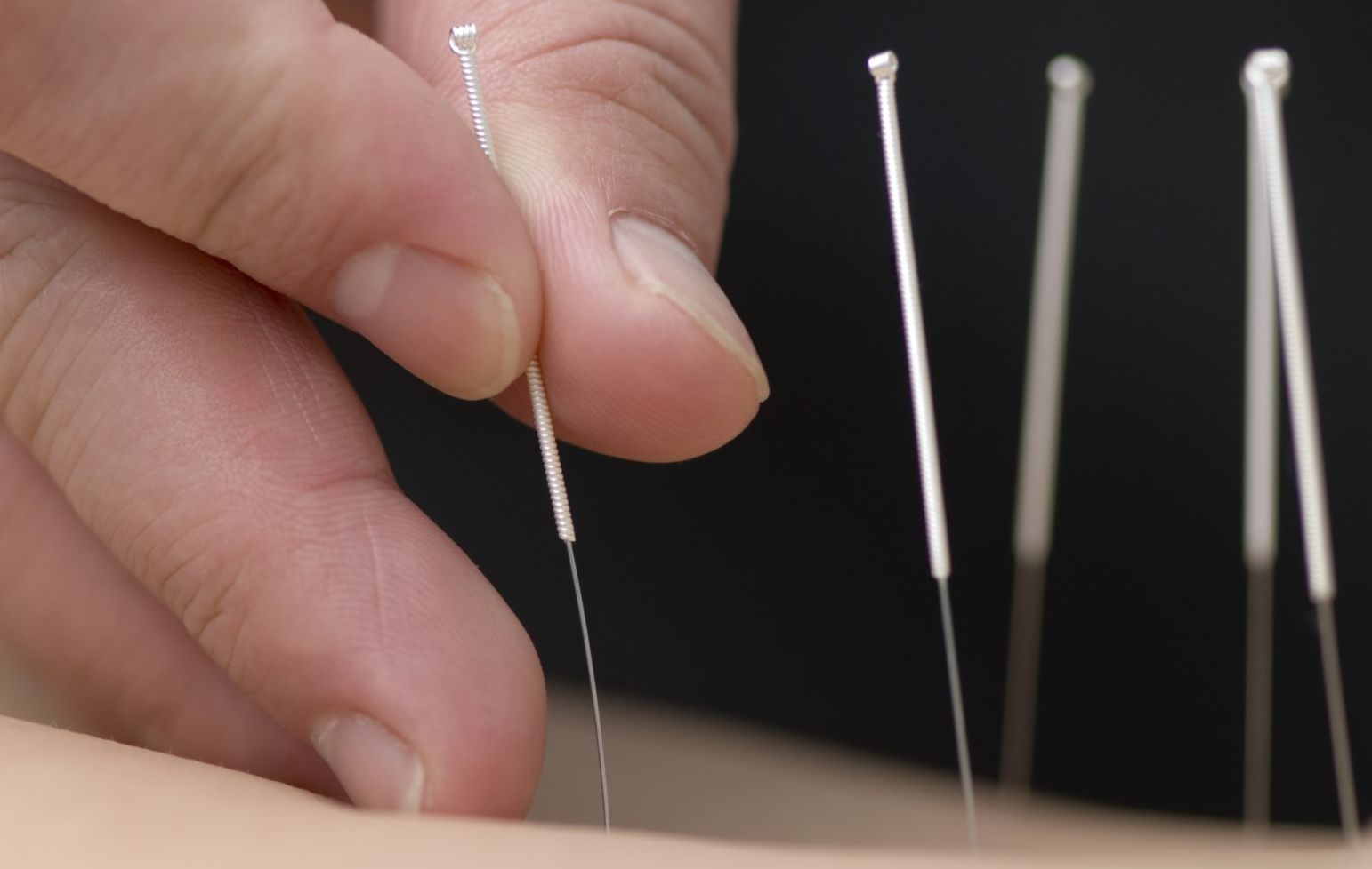 Medical Acupuncture
