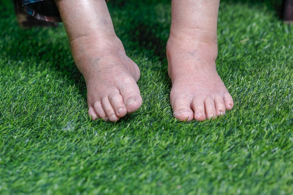 Edema ai piedi