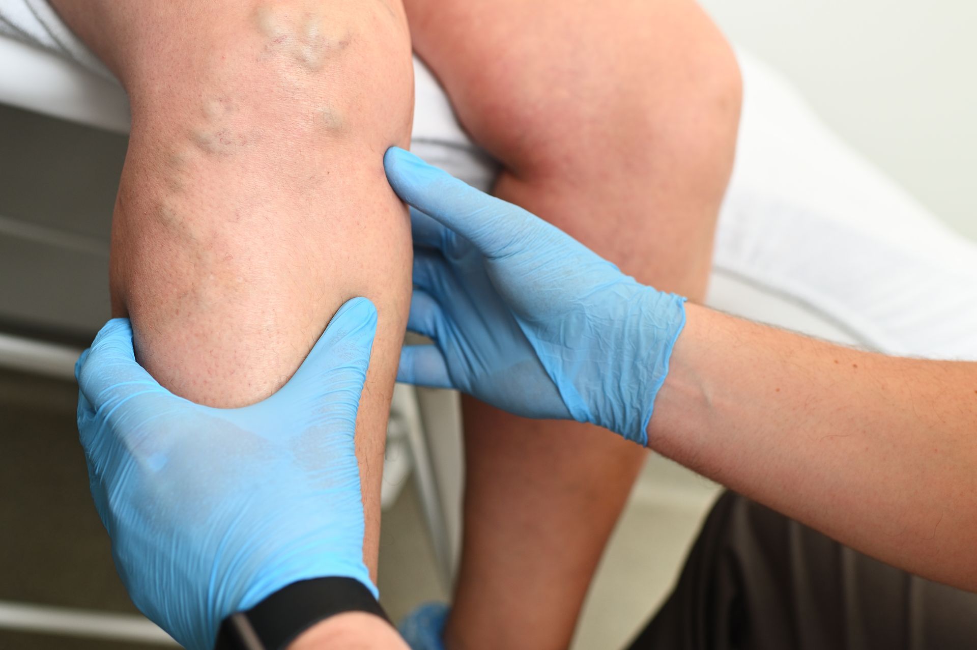 Leg being examined for varicose veins by a person wearing blue gloves.