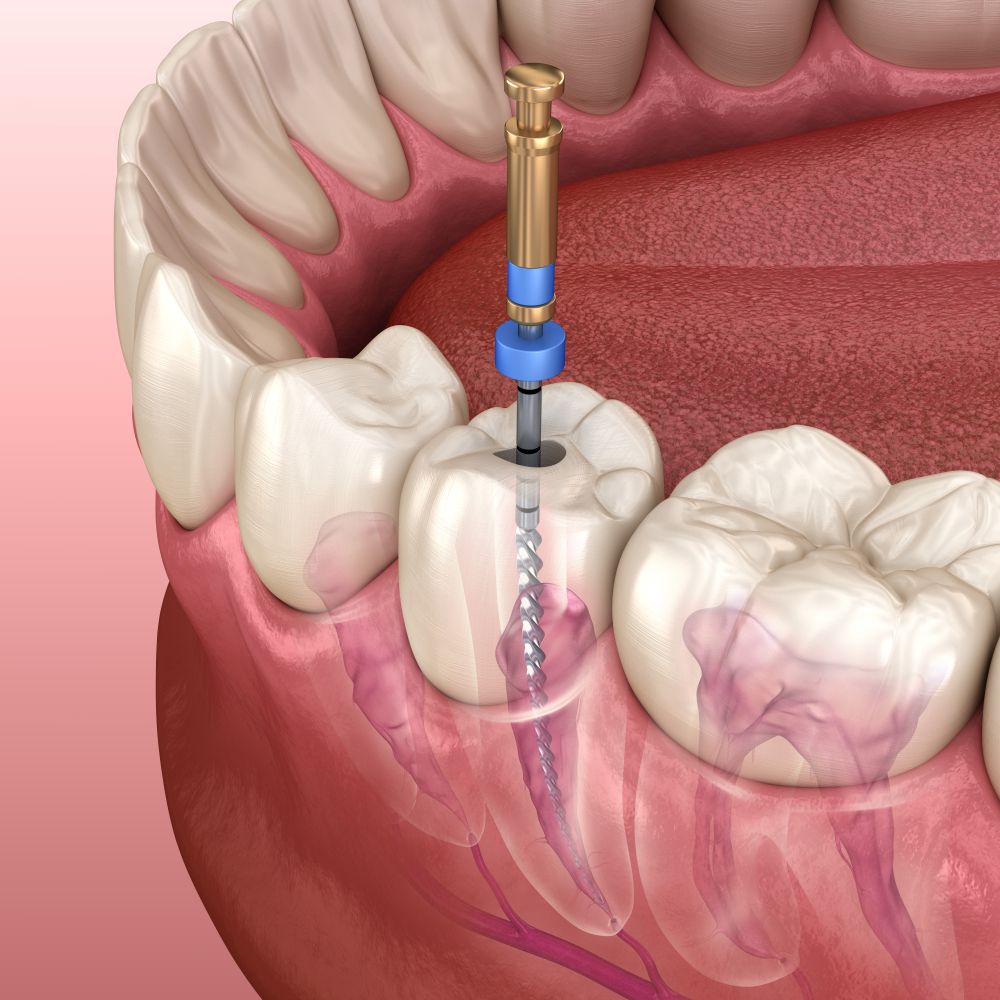 3d Rendering Of An Endodontic Root Canal Treatment Process — Aspire Dental in Townsville, QLD