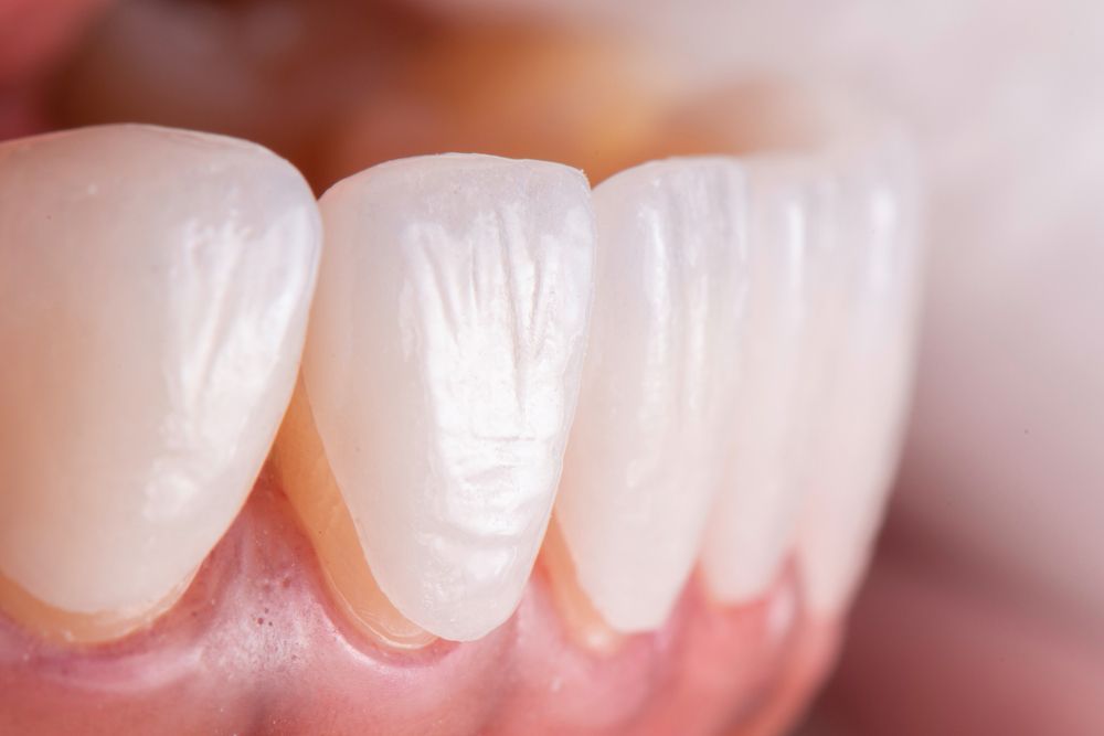 A Close Up Of A Person's Teeth And Gums — Aspire Dental in Townsville, QLD