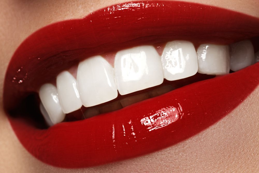 Perfect Smile After Teeth Bleaching — Aspire Dental in Townsville, QLD