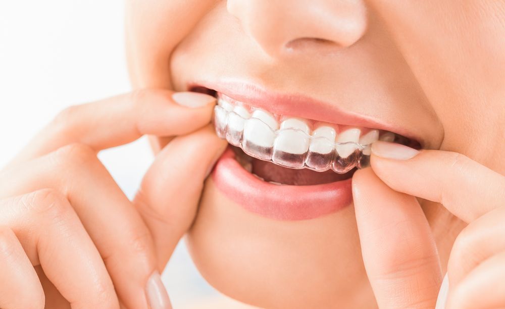 A Woman Is Putting Invisible Braces On Her Teeth — Aspire Dental in Townsville, QLD