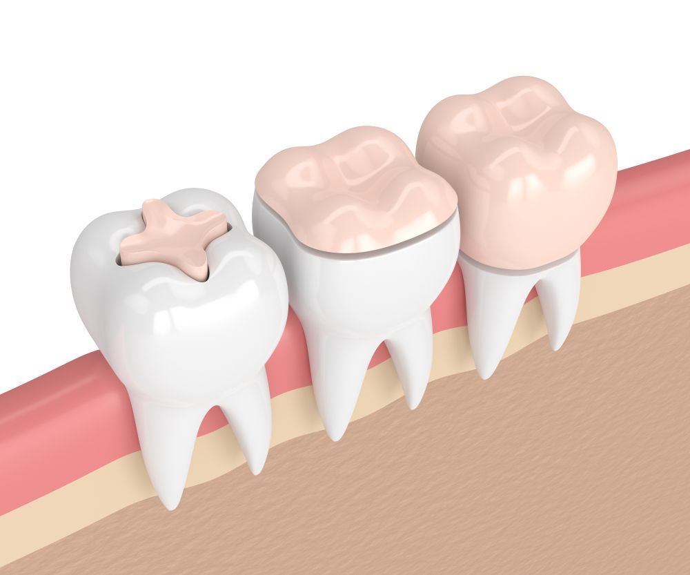 Illustration Of Three Teeth With Different Types Of Crown Fillings — Aspire Dental in Townsville, QLD