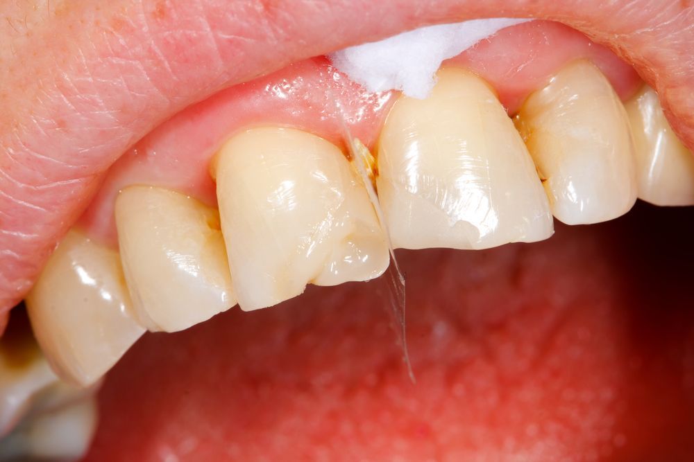 Close-up of a Person’s Upper Teeth Dental Filling