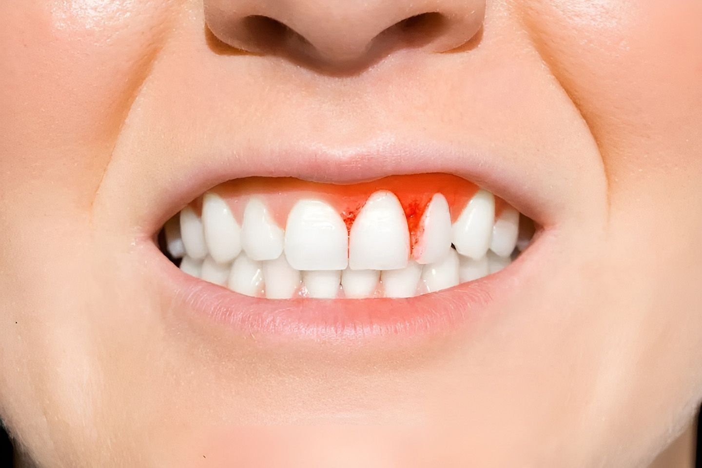 A Close Up Of A Person's Mouth With Bleeding Gums — Aspire Dental in Townsville, QLD