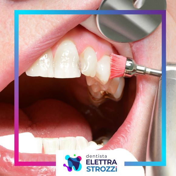 Dentista applica un gel sbiancante rosa ai denti anteriori con un pennellino, in una ripresa ravvicinata della bocca