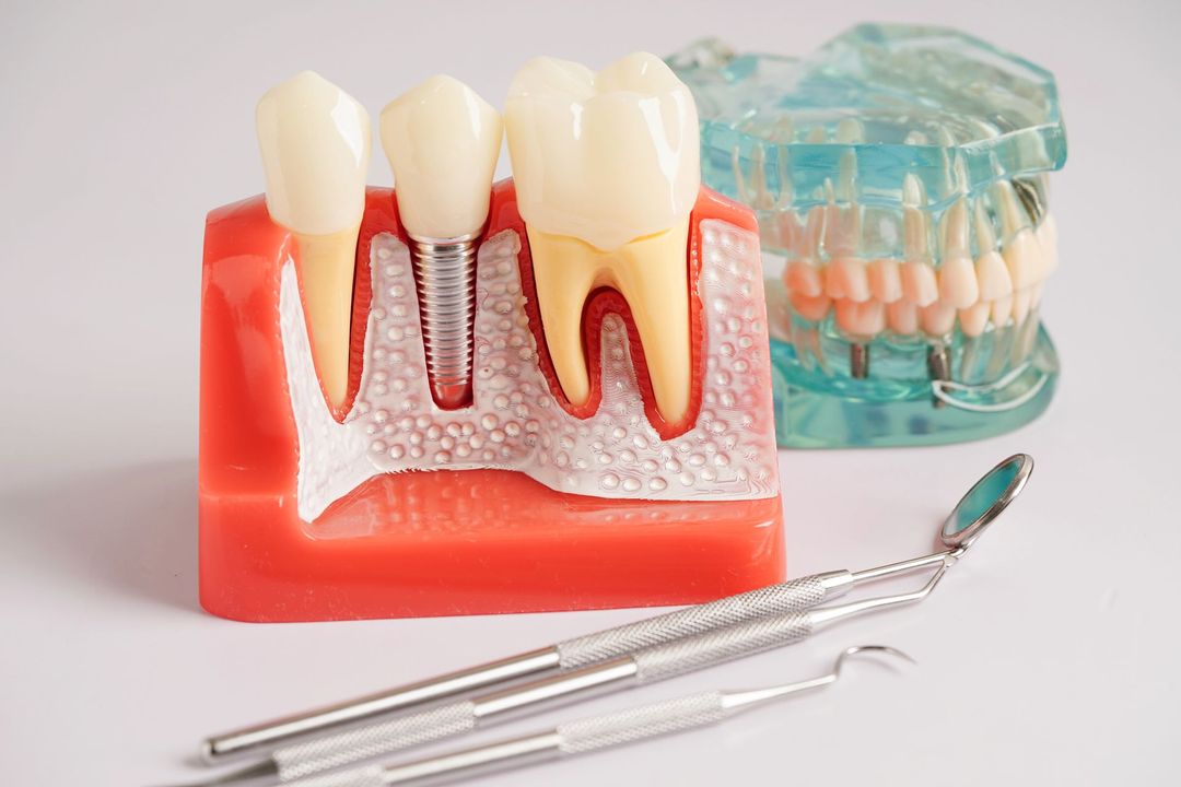Modello di impianto dentale con denti, sezione trasversale della gengiva, allineatore trasparente e strumenti odontoiatrici su una superficie bianca