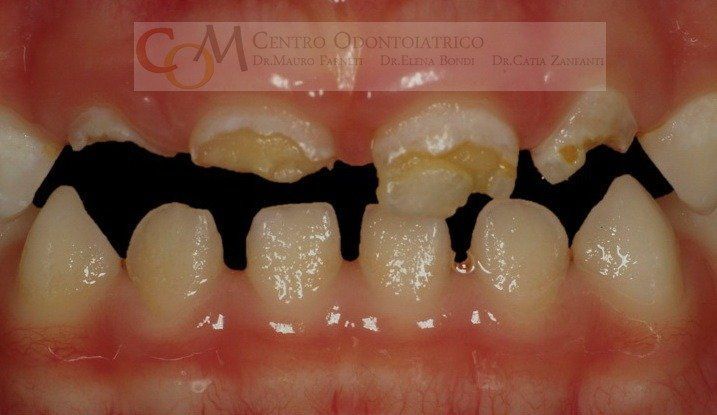 Primo piano di denti frontali gravemente cariati con cavità scure e smalto mancante sulle arcate superiore e inferiore.