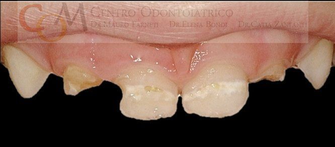 Primo piano di denti frontali gravemente cariati con smalto mancante e scolorimento giallastro.
