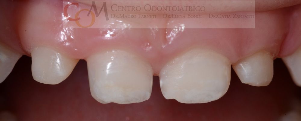 Primo piano dei denti frontali superiori con spazi visibili e discromie dentali.