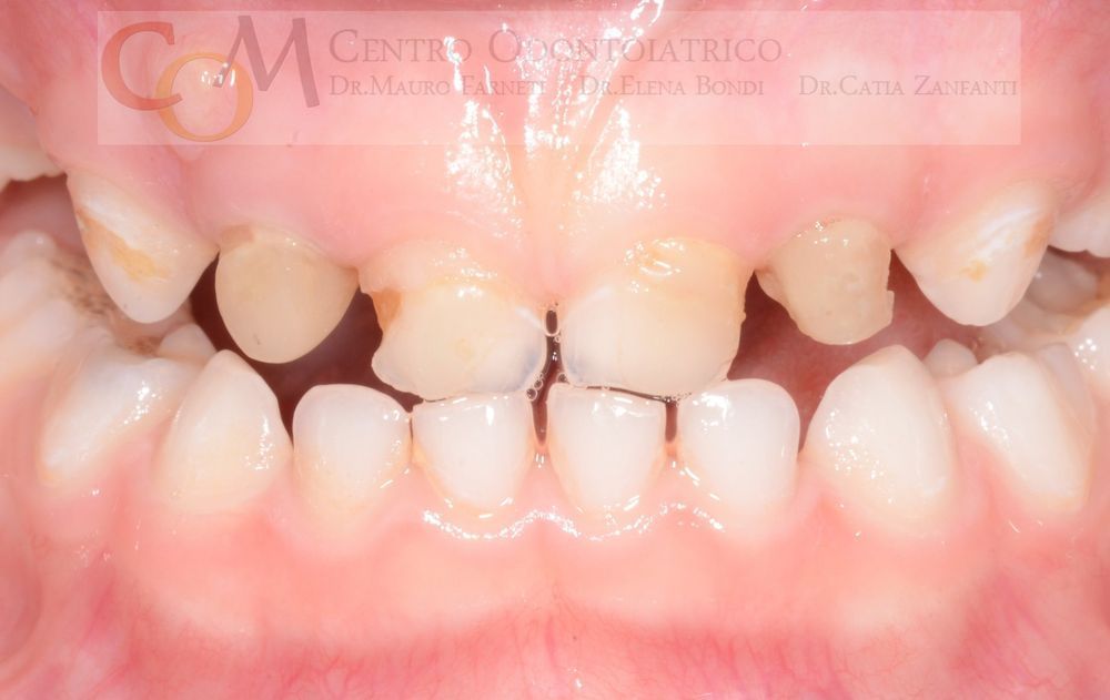 Primo piano dei denti di un bambino con spazi tra di loro e incisivi superiori disallineati, gengive rosa visibili
