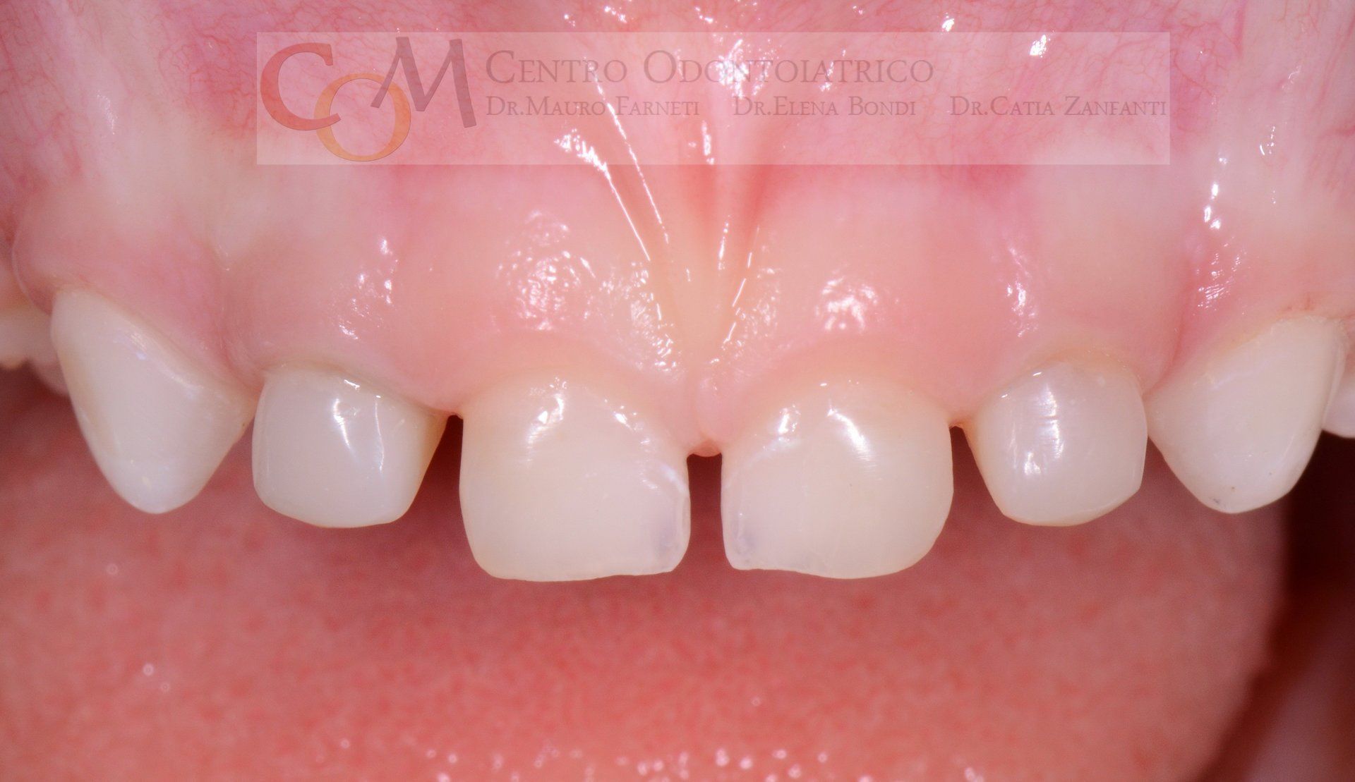 Primo piano dei denti frontali e delle gengive rosa di un bambino, che mostra un piccolo spazio tra gli incisivi superiori.