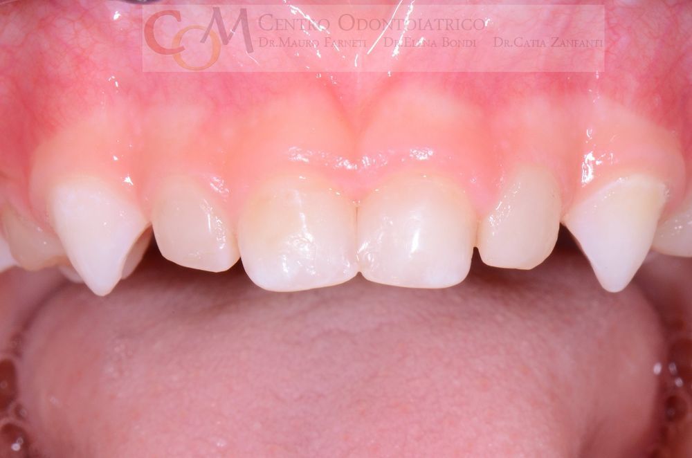 Primo piano dei denti frontali e delle gengive, con uno spazio visibile tra gli incisivi superiori.