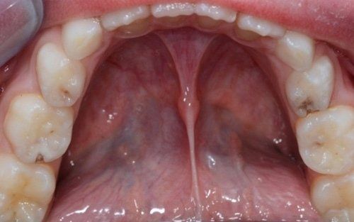 Primo piano di una bocca aperta che mostra il palato superiore e i denti.