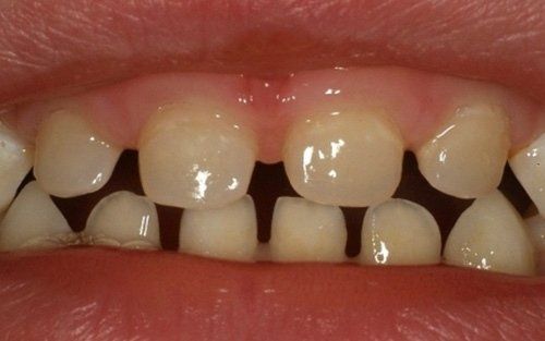 Primo piano della bocca di un bambino che mostra gli spazi tra gli incisivi superiori e inferiori.