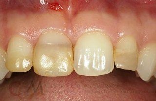 Primo piano dei denti frontali superiori con un dente scheggiato e scolorito e gengive irritate.