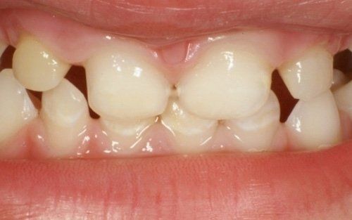 Primo piano dei denti incisivi di un bambino con spazi tra di loro e denti affollati, bocca leggermente aperta.