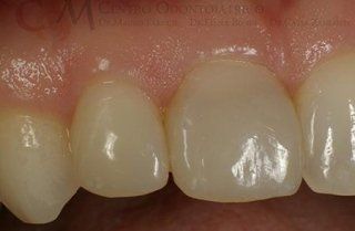 Primo piano dei denti frontali superiori con un piccolo spazio e smalto leggermente ingiallito.