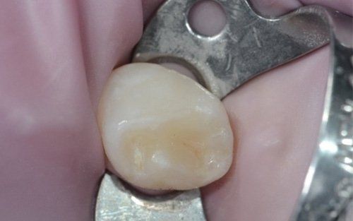 Un dente molare tenuto in uno strumento odontoiatrico metallico su sfondo rosa.