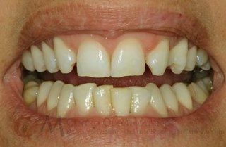 Primo piano di una bocca che mostra denti affollati e uno spazio visibile tra gli incisivi superiori.