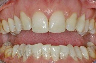 Primo piano di denti con incisivi centrali superiori più lunghi e leggermente irregolari, che mostra un confronto dell'allineamento dentale.
