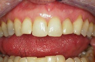 Primo piano di una bocca che mostra i denti superiori e inferiori con le labbra leggermente dischiuse, rivelando un piccolo spazio tra gli incisivi.