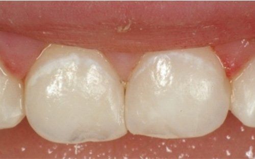Primo piano di due dentini da latte incisivi con un piccolo spazio in una bocca rosa