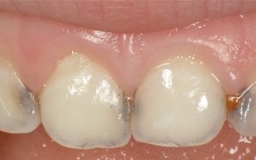 Primo piano di denti frontali con uno spazio centrale e corone dentali bianche.