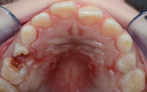 Arcata dentale superiore e palato con una cavità scura nella zona del molare sinistro.