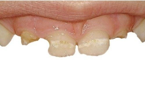Primo piano dei denti frontali superiori con difetti di smalto giallastro e uno spazio tra gli incisivi centrali.