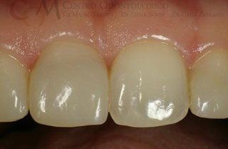 Primo piano di due incisivi centrali con una piccola scheggiatura sul dente di destra.