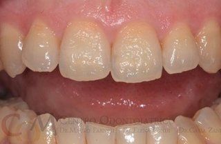 Primo piano dei denti frontali e delle gengive, che mostra i denti superiori e inferiori in una bocca.